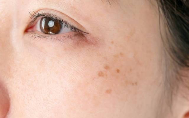 얼굴 노화 증상,피부노화 증상,기미