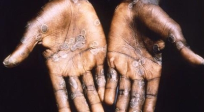 원숭이두창 이미지