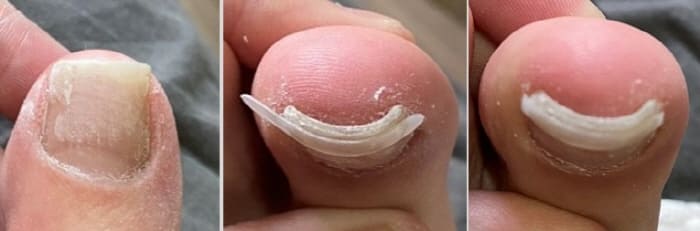 내성발툽자가교정하기