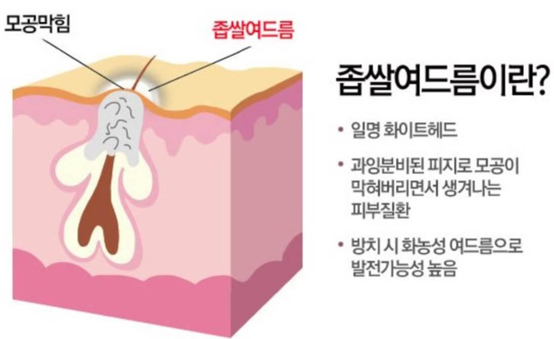 좁쌀여드름이 생기는 원인