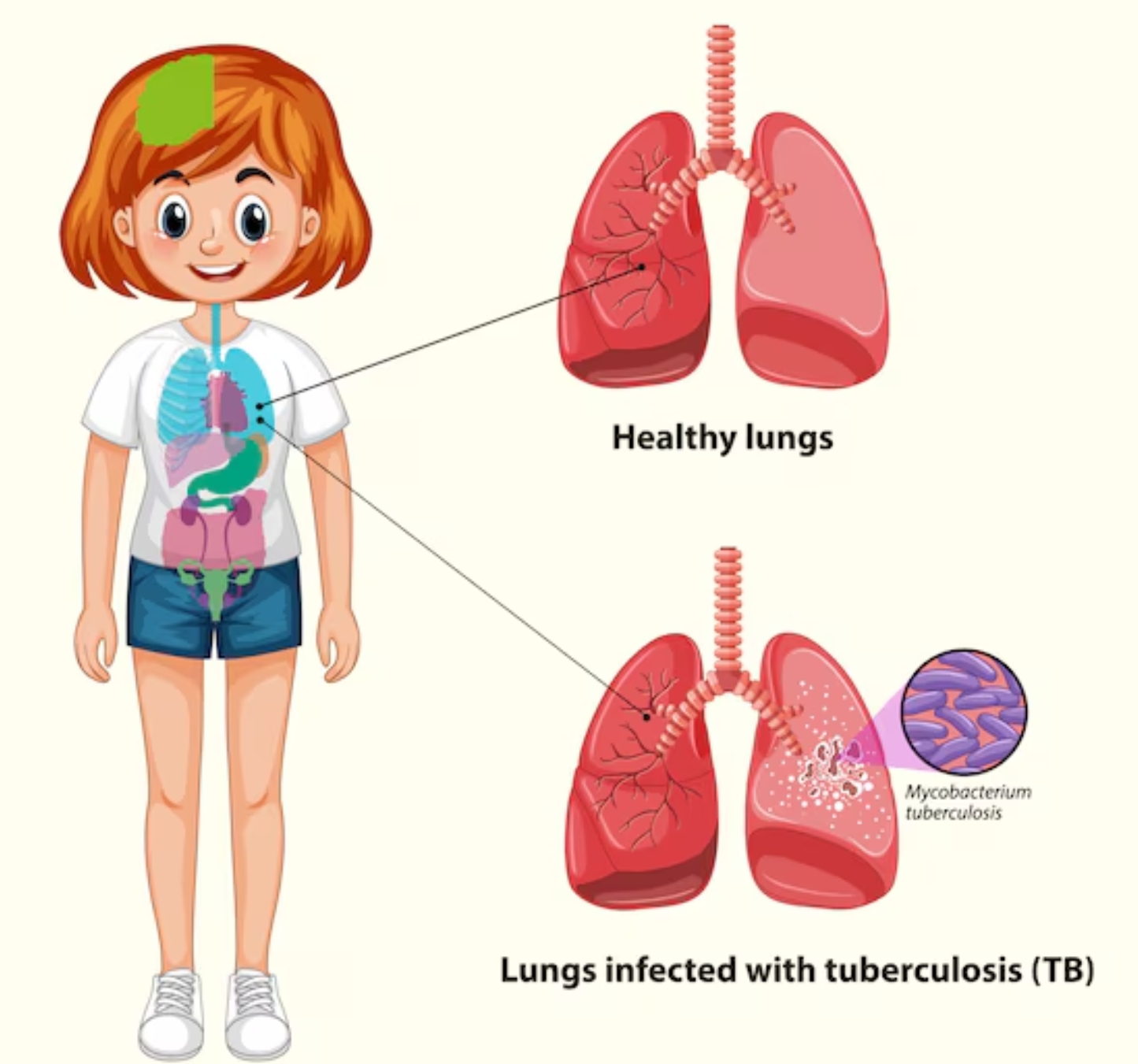 결핵 감염 전 후 폐 이미지 비교