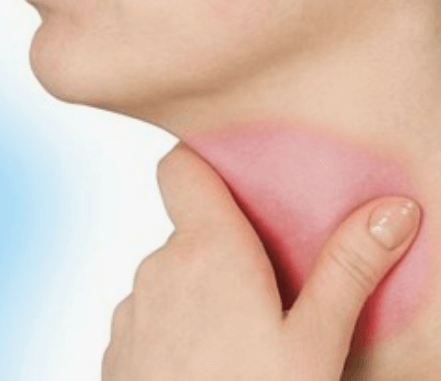 목감기 빨리 낫는 법 증상 좋은 차 좋은 음식