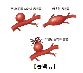 동맥류&#44; 서울아산병원