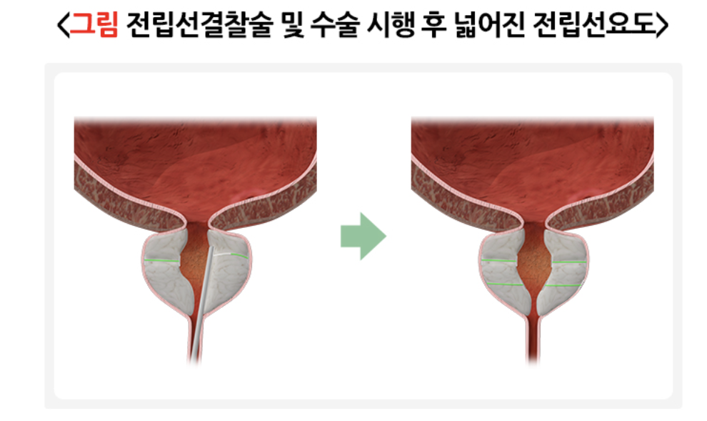 전립선결찰술
