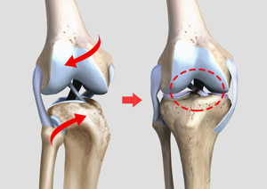무릎십자인대파열