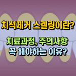 치석제거 스켈링이란 치료과정 해야하는 이유 썸네일