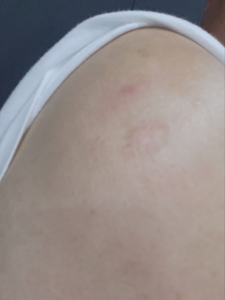 주사 맞은 자리 사진