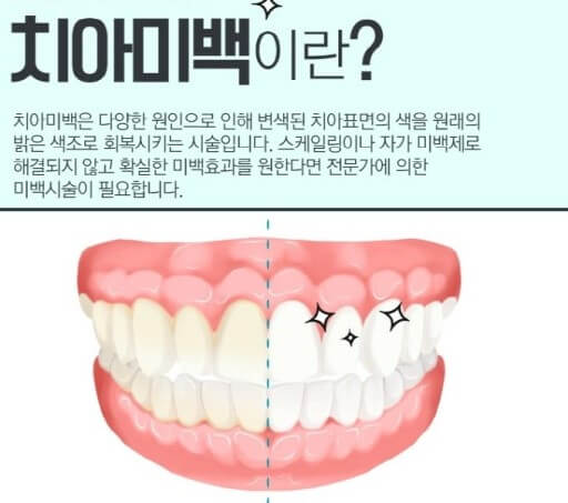 치아미백 궁금증