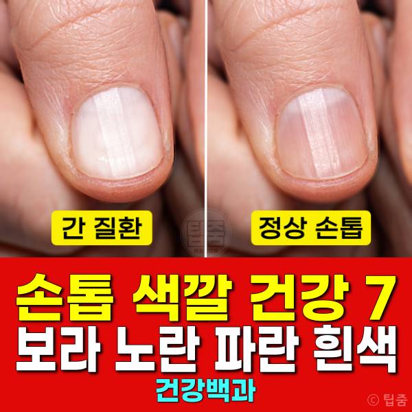 손톱 색깔 건강 손톱색깔 보라색 노란색 파란색 흰색 검은색 원인