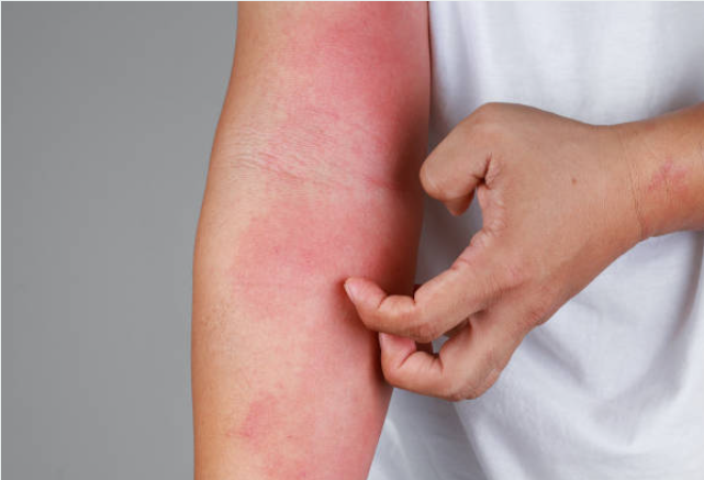 아토피 원인부터 관리까지