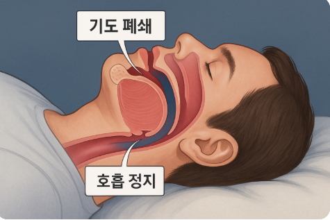 수면무호흡증의 기도 폐쇄와 호흡 정지를 한눈에 이해할 수 있도록 옆 얼굴 단면도를 표현한 이미지