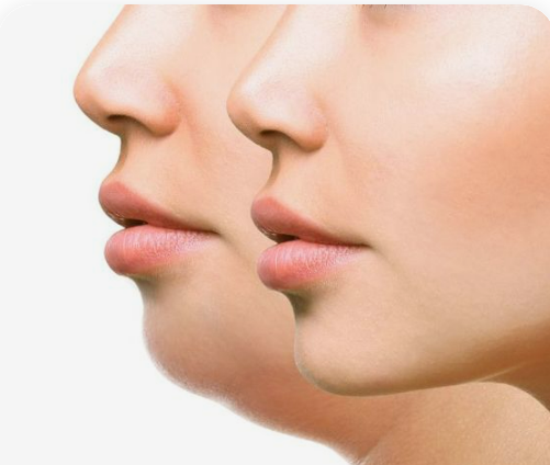 리프팅 전 후 사진