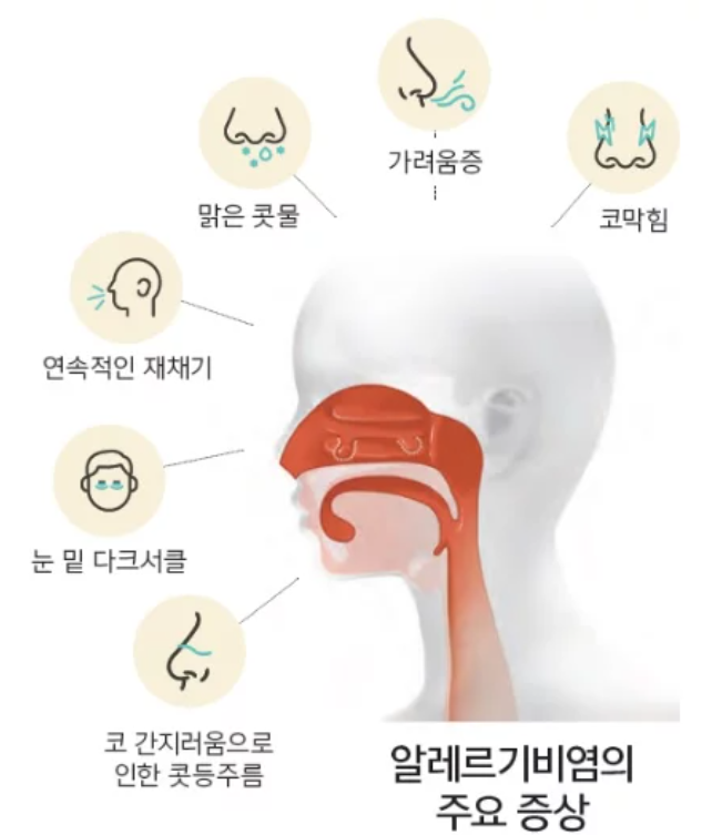 비염 20년차가 눈물 흘리며 인정한 단 하나의 치료법 (실제 후기)