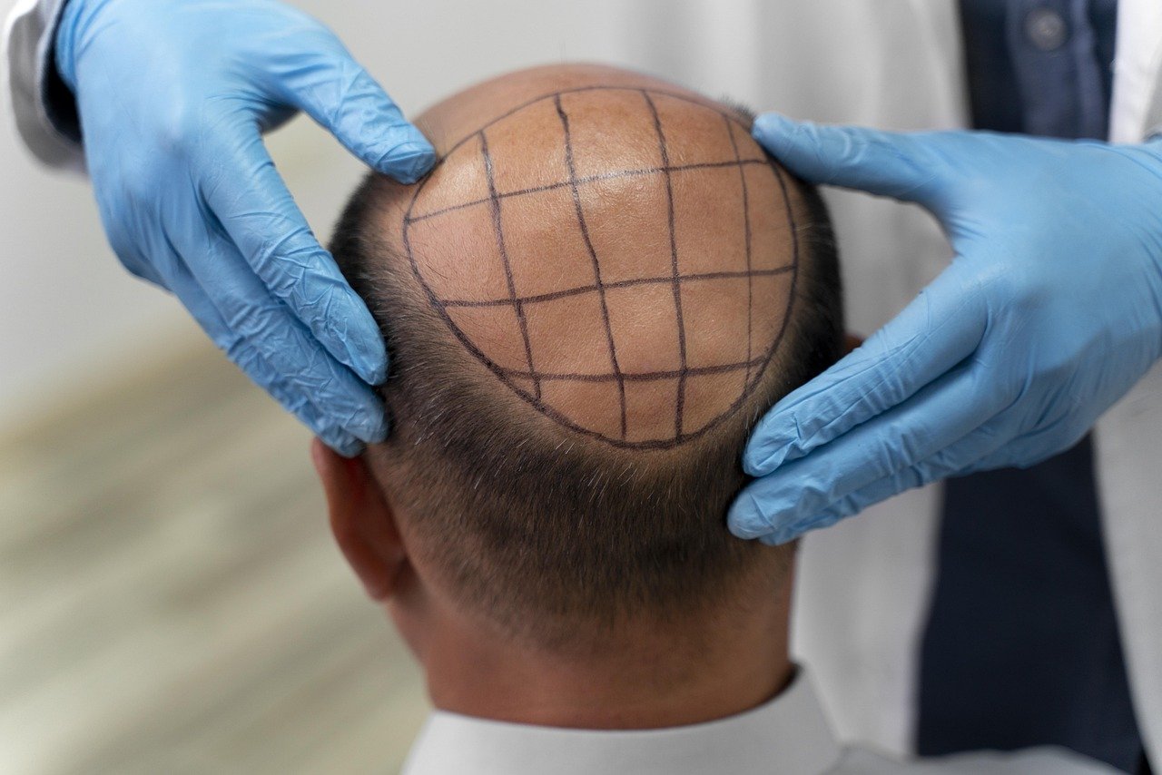 모발이식, hair implant