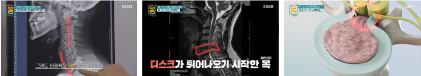 거북목, 일자목, 디스크 초기상태