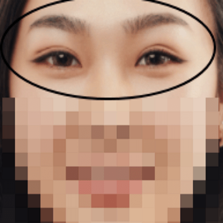 이마거상술 후 여성의 사진