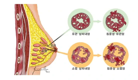 유방암 초기증상
