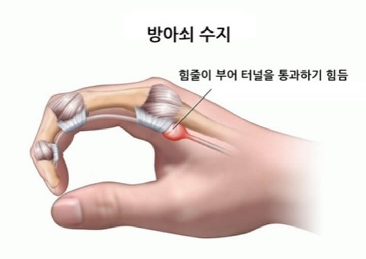 방아쇠수지증후군-모든것