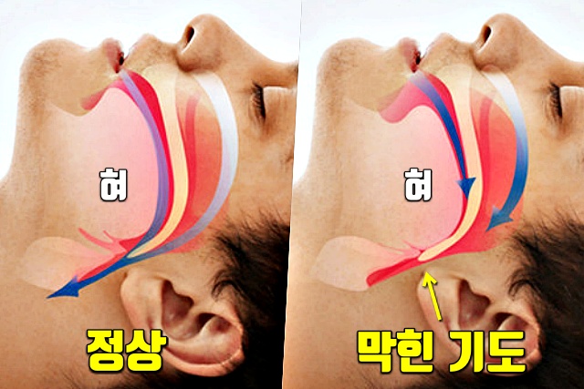 살찐 혀 깨물었을때 기도가 막히는 수면무호흡증, 내장지방 빼는법, 건강 팁줌 매일꿀정보
