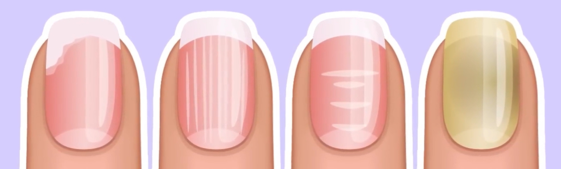 발톱이 검게 변하는 이유