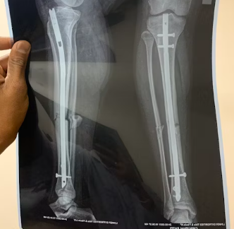 통풍 치료법 진단 기준 합병증