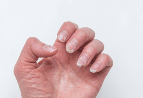 손톱 갈라짐