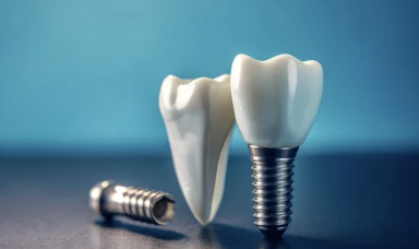 임플란트 모형 사진