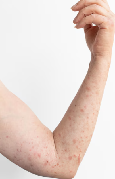 대상포진 초기증상 18