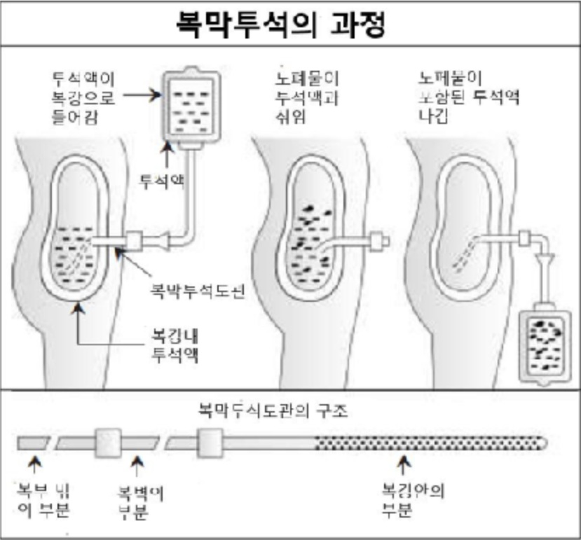 신장 투석 생존기간