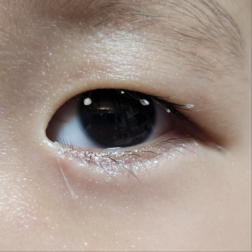 수술 8일 후 눈