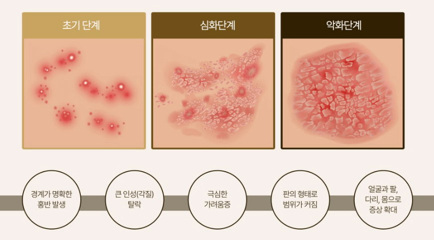 건선 증상