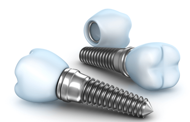 동탄-임플란트-잘하는-치과-동탄-임플란트-유명한-곳-동탄-임플란트-가격