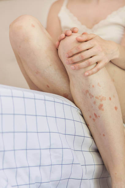 대상포진 예방접종 가격