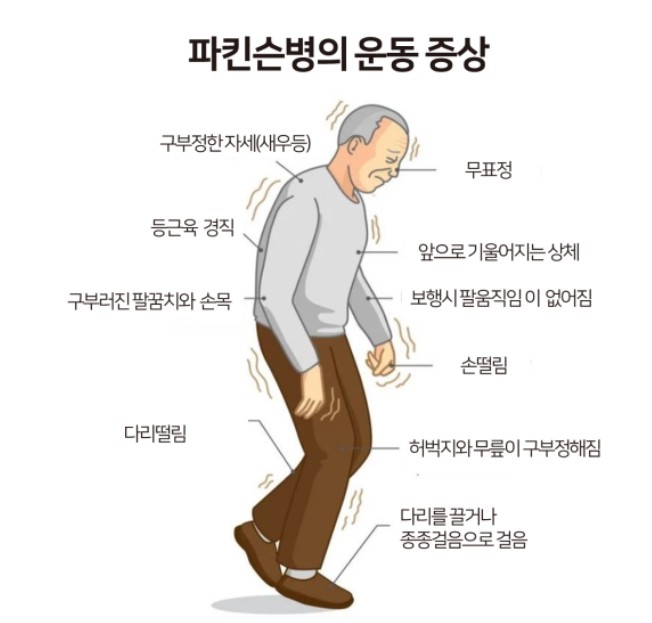 파킨슨병의 특징적인 모습