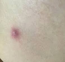 종기가 생기는 이유