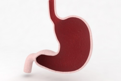 역류성 식도염 목이물감