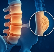 골다공증에 좋은 음식