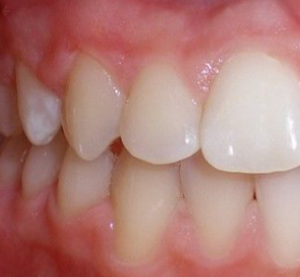 잇몸이 부었을 때 대처 방법