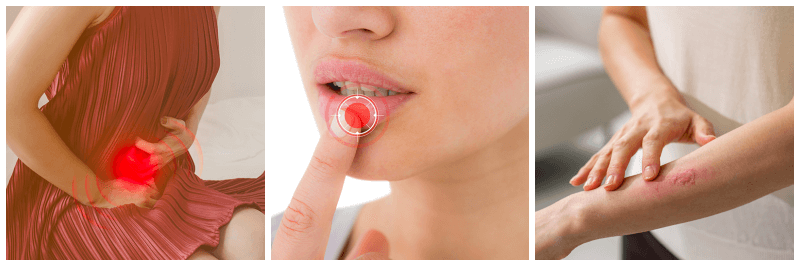 헤르페스 2형, 1형, 대상포진 사진