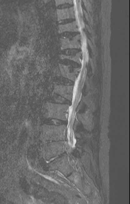 lumbar spune mri sagittal.