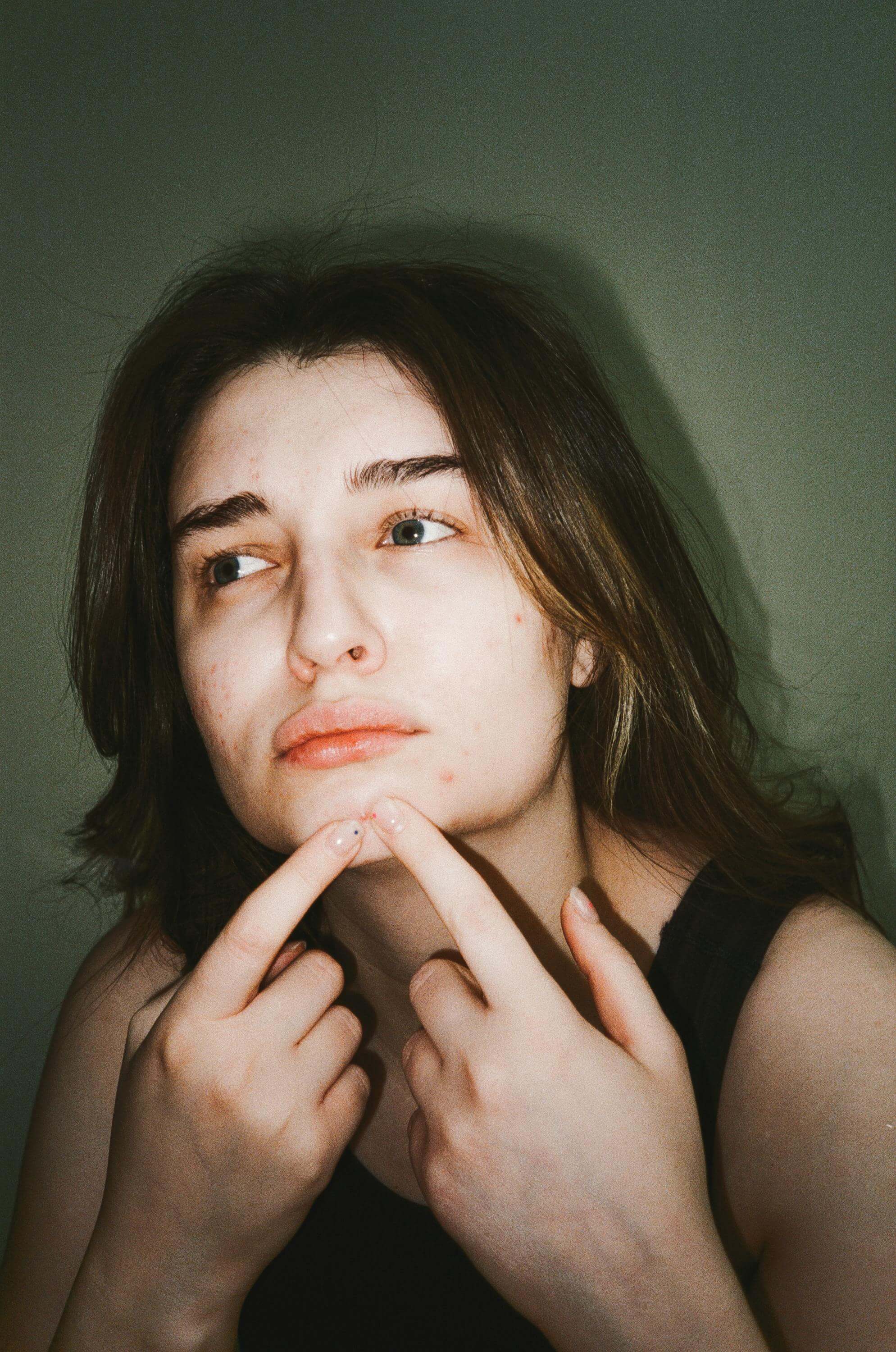 여드름 빨리 없애는법 여드름 연고 흉터 제거