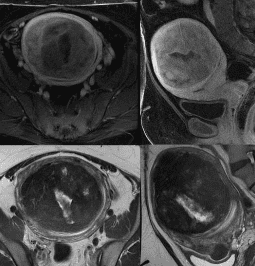 자궁근종 증상 7가지, 수술후 회복기간