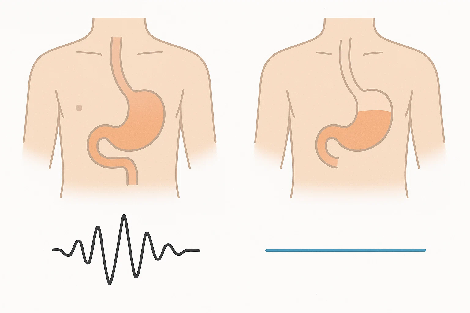 정상적인 저음의 꾸르륵 소리와 고음 금속성 장음 또는 무음을 대비