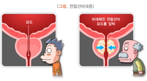전립선비대증
