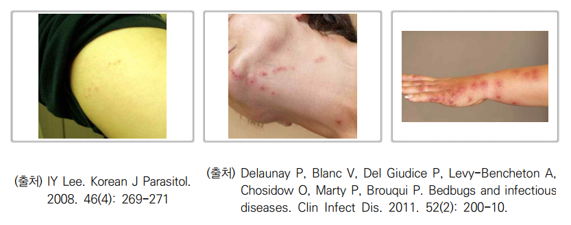 빈대물렸을때 증상