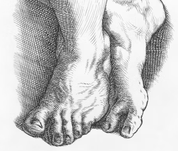 무좀 증상 치료법 원인 발톱 손톱