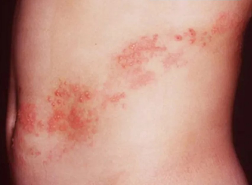 대상포진 초기증상 전염 예방 치료방법 대상포진에 좋은 음식