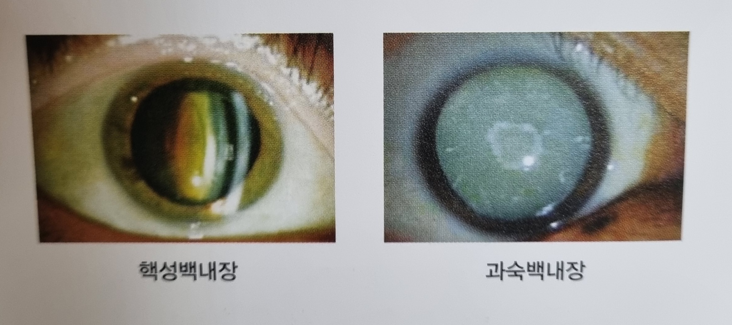 백내장 종류