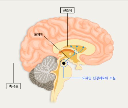 파킨슨병 초기증상
