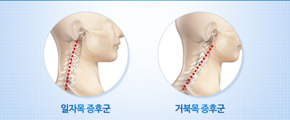 일자목과 거북목